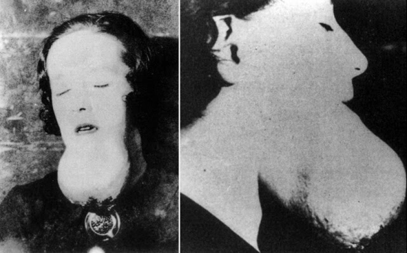 Radium girls: the story of the "living dead" that changed the world