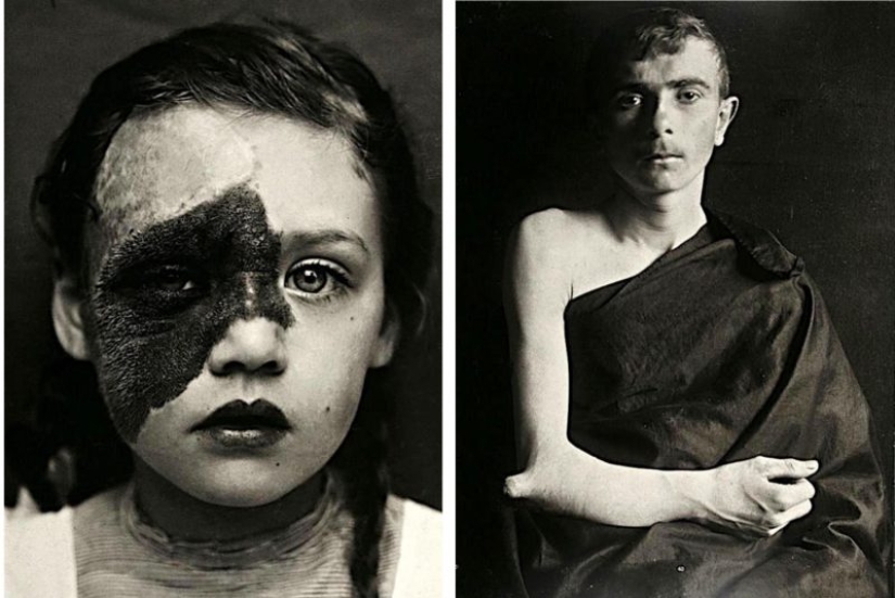 Retratos de dolor: impactantes fotografías de los pacientes a partir del siglo xix que sufren de enfermedades graves