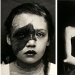 Retratos de dolor: impactantes fotografías de los pacientes a partir del siglo xix que sufren de enfermedades graves