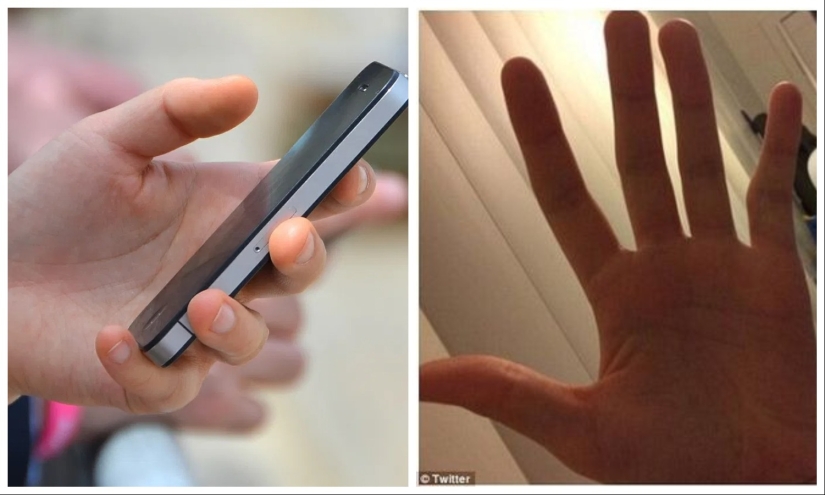 Smart Pinky: smartphone users are increasingly experiencing finger deformity