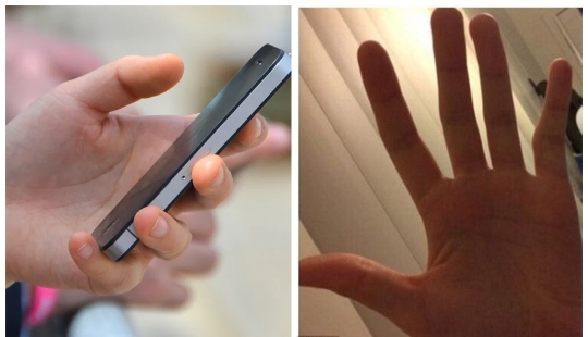 Smart Pinky: smartphone users are increasingly experiencing finger deformity