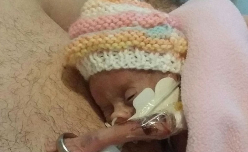 The amazing story of a tiny baby who survived no matter what