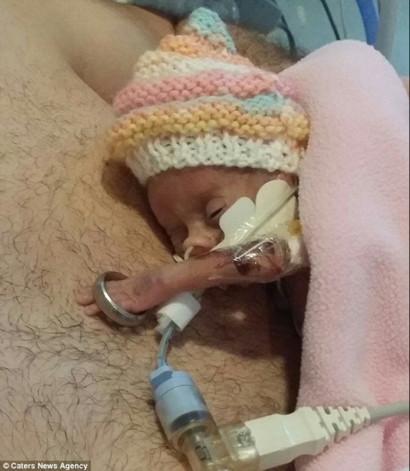 The amazing story of a tiny baby who survived no matter what