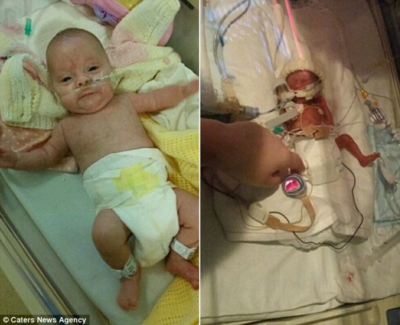 The amazing story of a tiny baby who survived no matter what