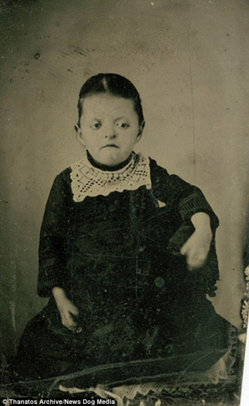 The harsh 19th century: a collection of archival photographs of people with deformities