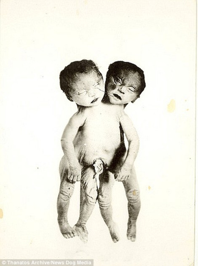 The harsh 19th century: a collection of archival photographs of people with deformities