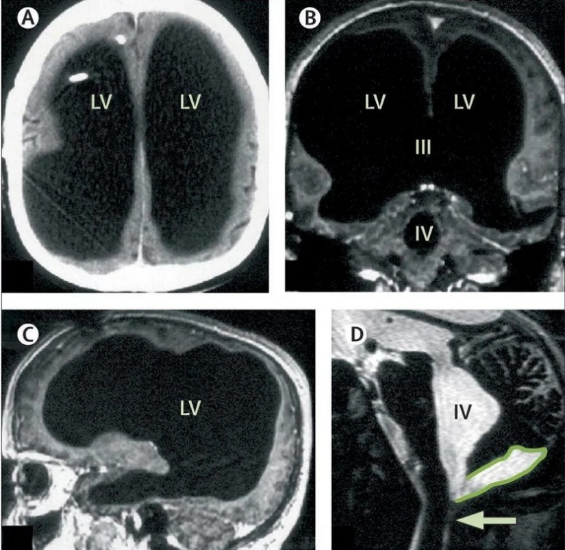 The man lived without a brain until the age of 44 and did not notice it