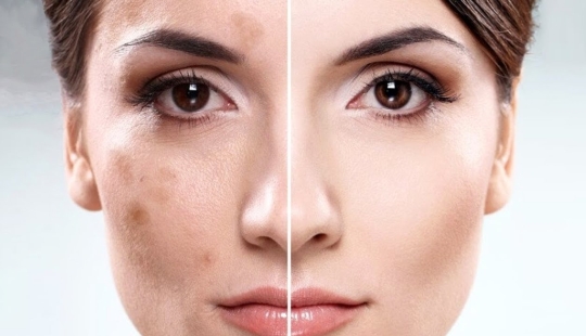 The result is obvious: as computers and smartphones spoil your skin