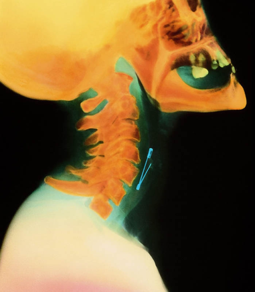 The strangest X-rays