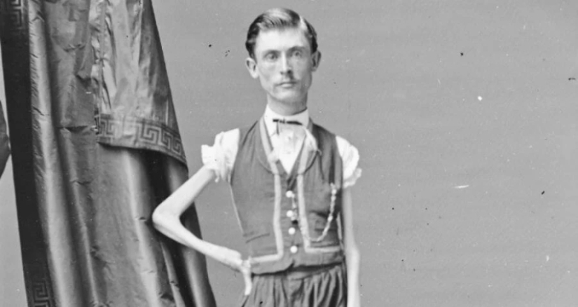 The Tragic Story of the &quot;Living Skeleton&quot; Isaac Sprague