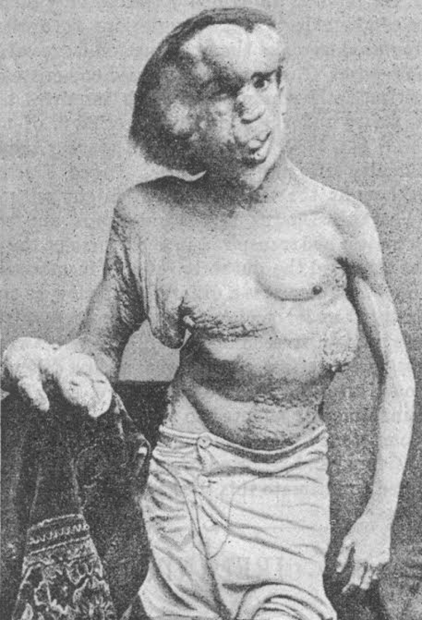 Un Fenómeno con un Alma Hermosa: La historia de Joseph Merrick - El Hombre Elefante