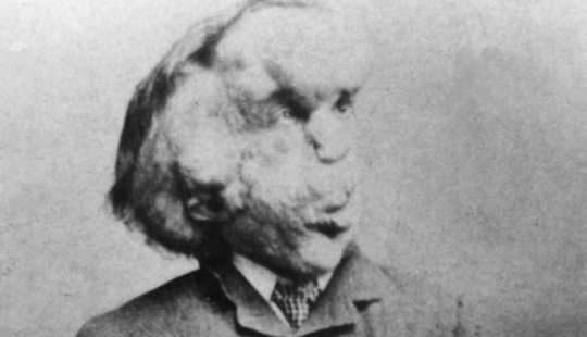 Un Fenómeno con un Alma Hermosa: La historia de Joseph Merrick - El Hombre Elefante