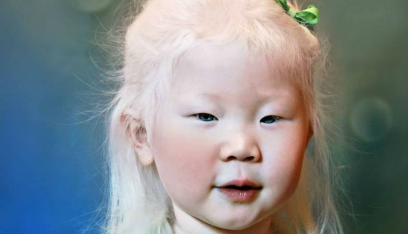 What do albinos of different nationalities and races look like