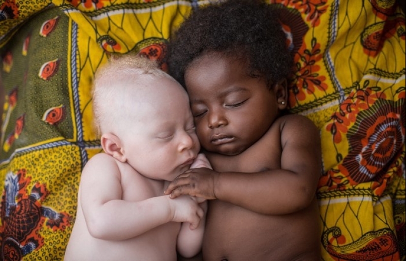 What do albinos of different nationalities and races look like