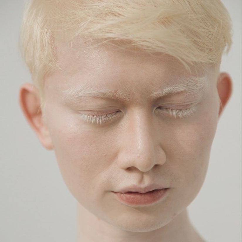 What do albinos of different nationalities and races look like