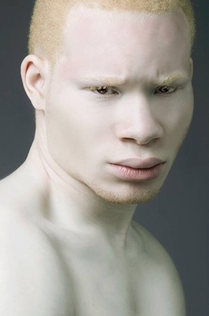 What do albinos of different nationalities and races look like