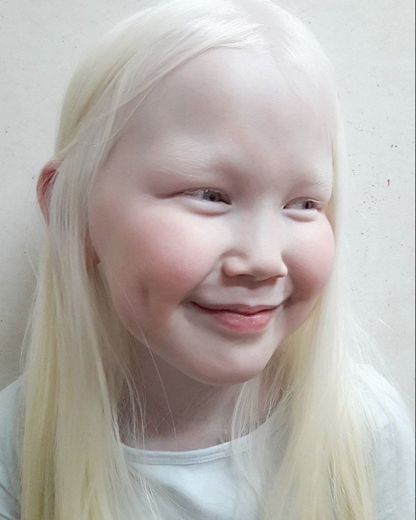 What do albinos of different nationalities and races look like