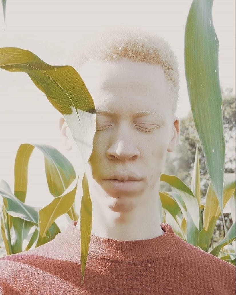 What do albinos of different nationalities and races look like