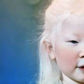 What do albinos of different nationalities and races look like