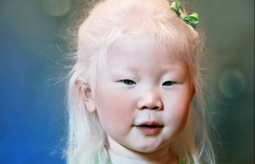 What do albinos of different nationalities and races look like