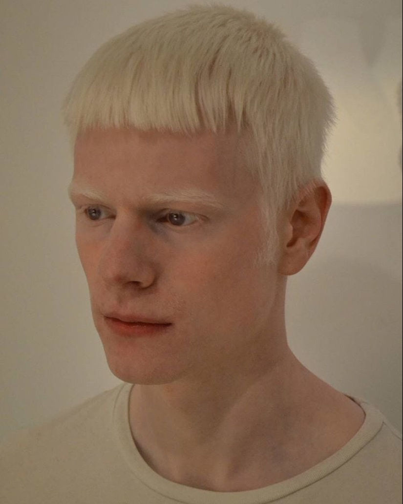 What do albinos of different nationalities and races look like