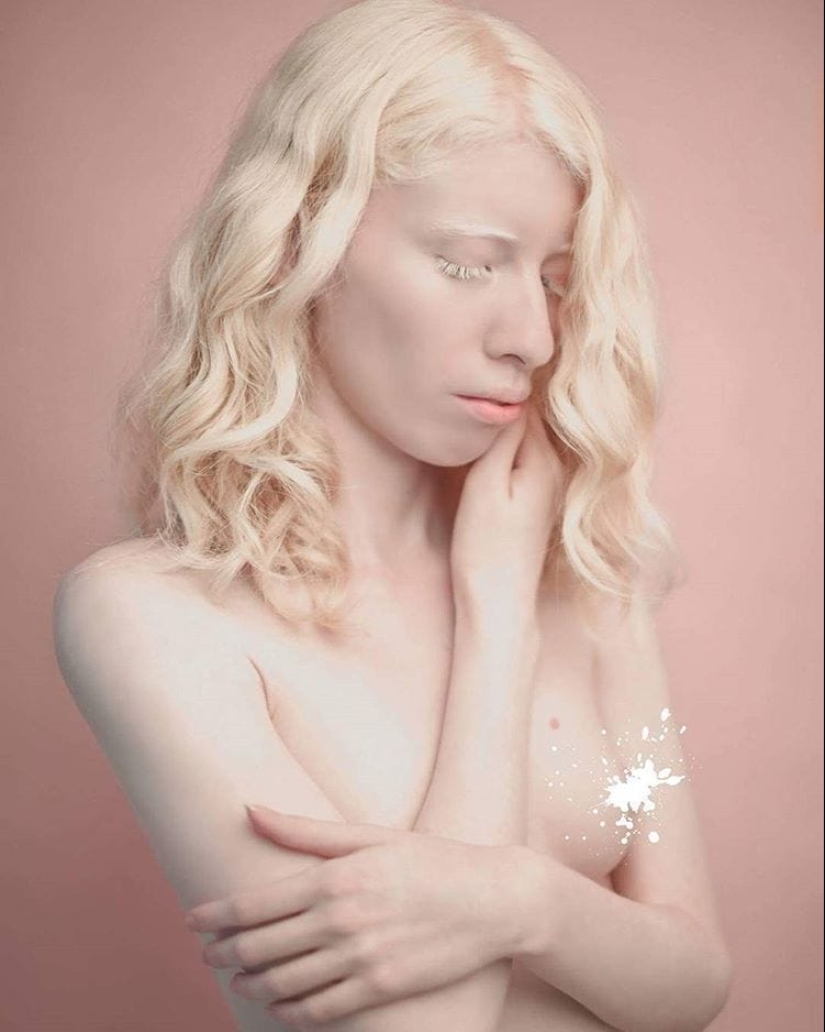 What do albinos of different nationalities and races look like