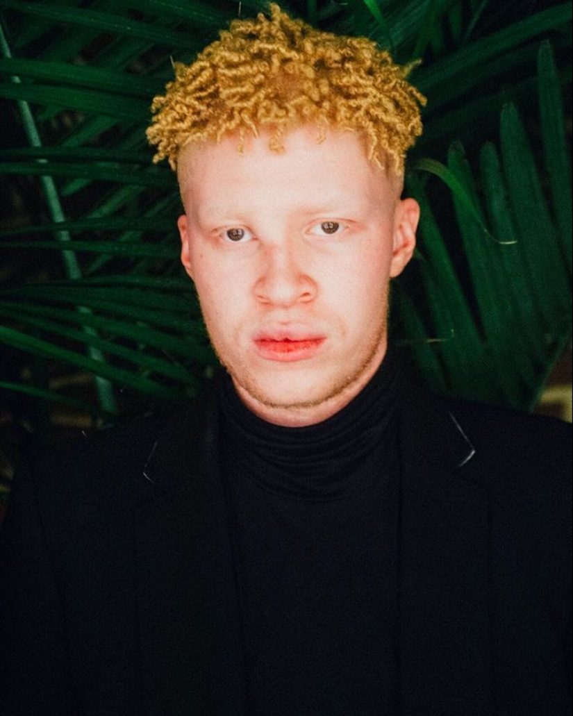 What do albinos of different nationalities and races look like