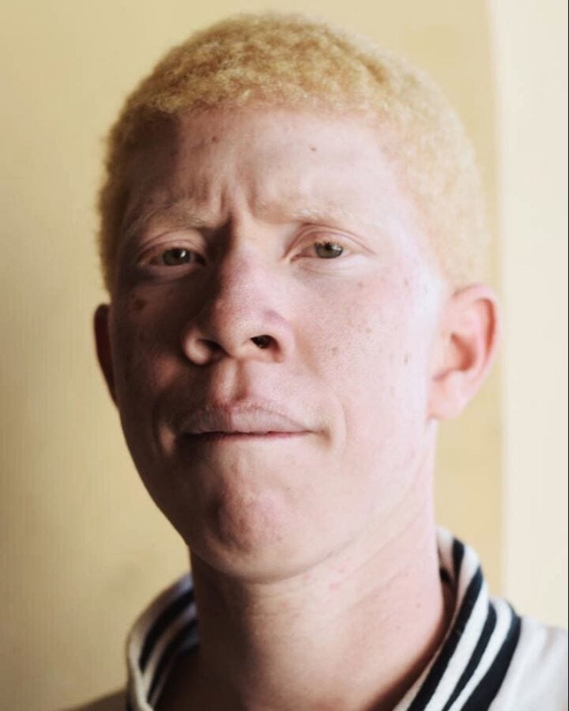 What do albinos of different nationalities and races look like