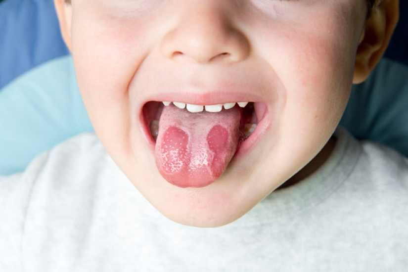 Where are the cracks on the tongue from and how dangerous is it?