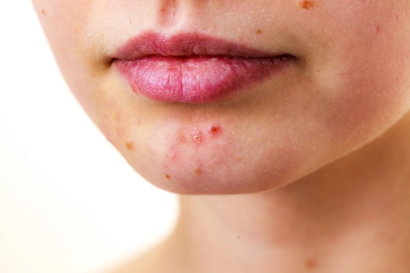 Winter, cold, cracked lip: 8 tips for skin care in the cold season