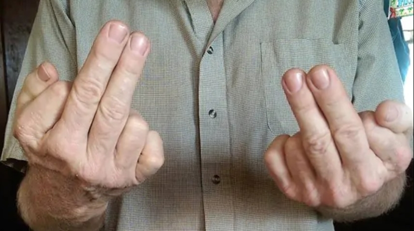 17 rare anomalies of human hands 17 rare anomalies of human hands