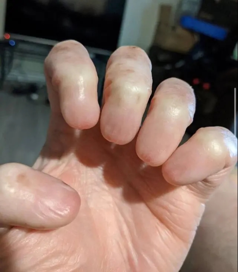 17 rare anomalies of human hands 17 rare anomalies of human hands