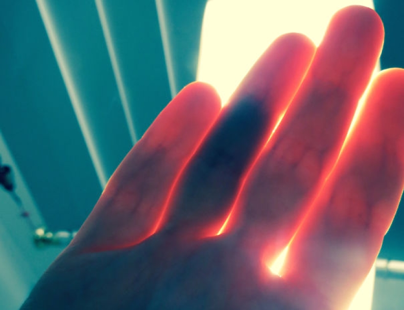 17 rare anomalies of human hands 17 rare anomalies of human hands