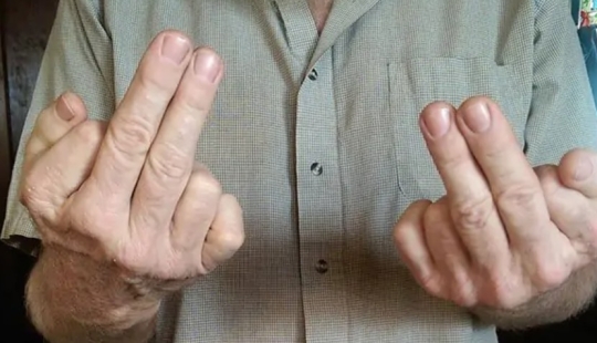 17 rare anomalies of human hands 17 rare anomalies of human hands