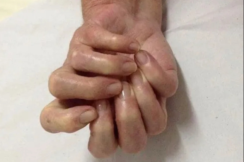 17 rare anomalies of human hands 17 rare anomalies of human hands