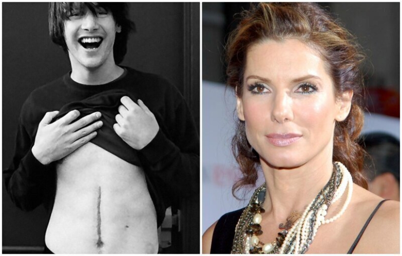 20 stories of the appearance of scars in Russian and foreign stars 20 stories of the appearance of scars in Russian and foreign stars