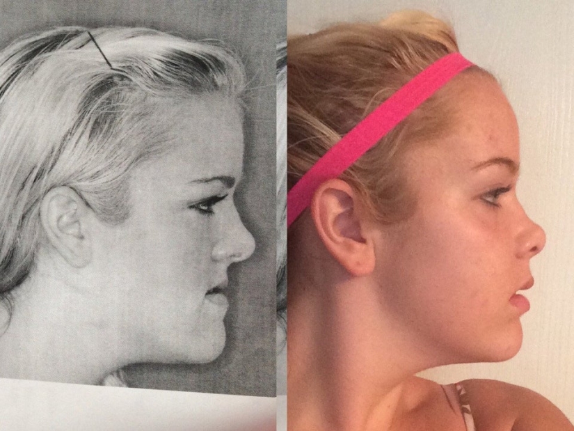 22 photos of people who went under the surgeon's knife and never regretted it