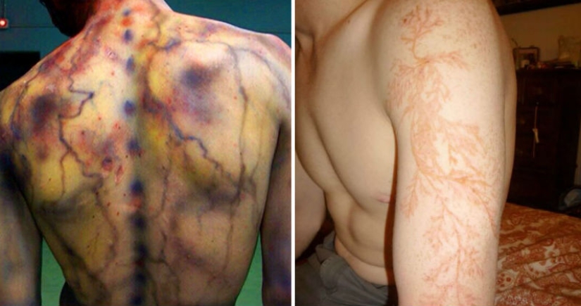 After discharge: what happens to a man who was struck by lightning