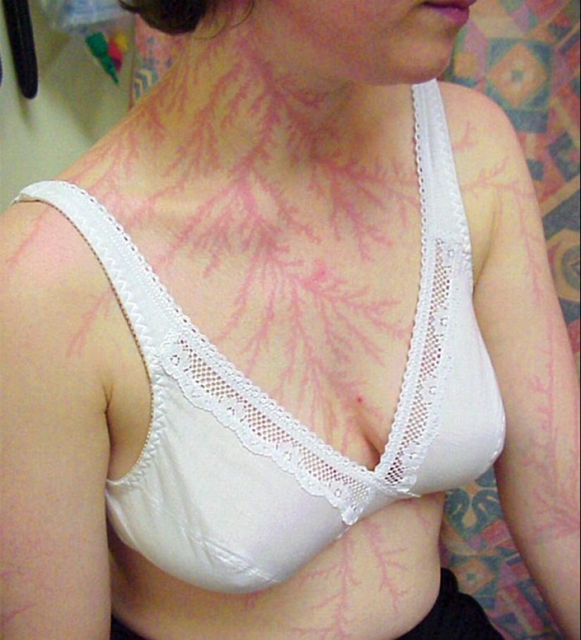 After discharge: what happens to a man who was struck by lightning