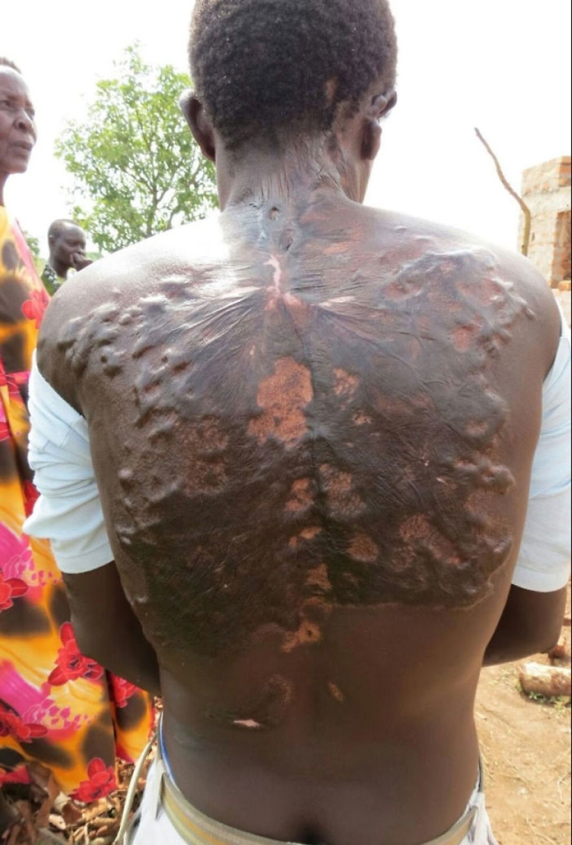 After discharge: what happens to a man who was struck by lightning