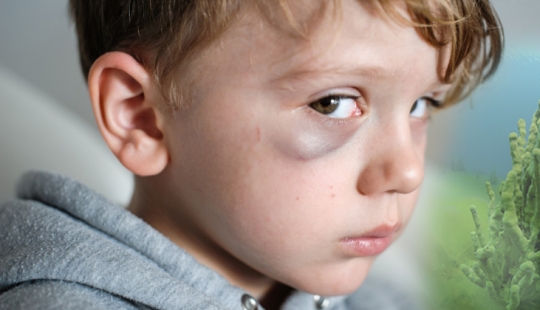 Badyaga: it saves you from bruising, and you don't even know it's not a plant