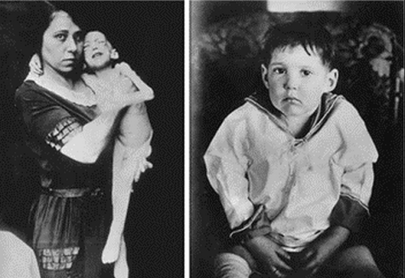 Cómo han cambiado las vidas de los diabéticos en los últimos 100 años