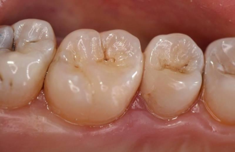 Cómo la caries se apoderó del mundo