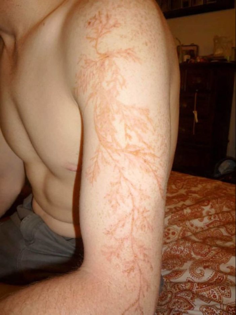 Después de la descarga: ¿qué le sucede a un hombre que fue alcanzado por un rayo