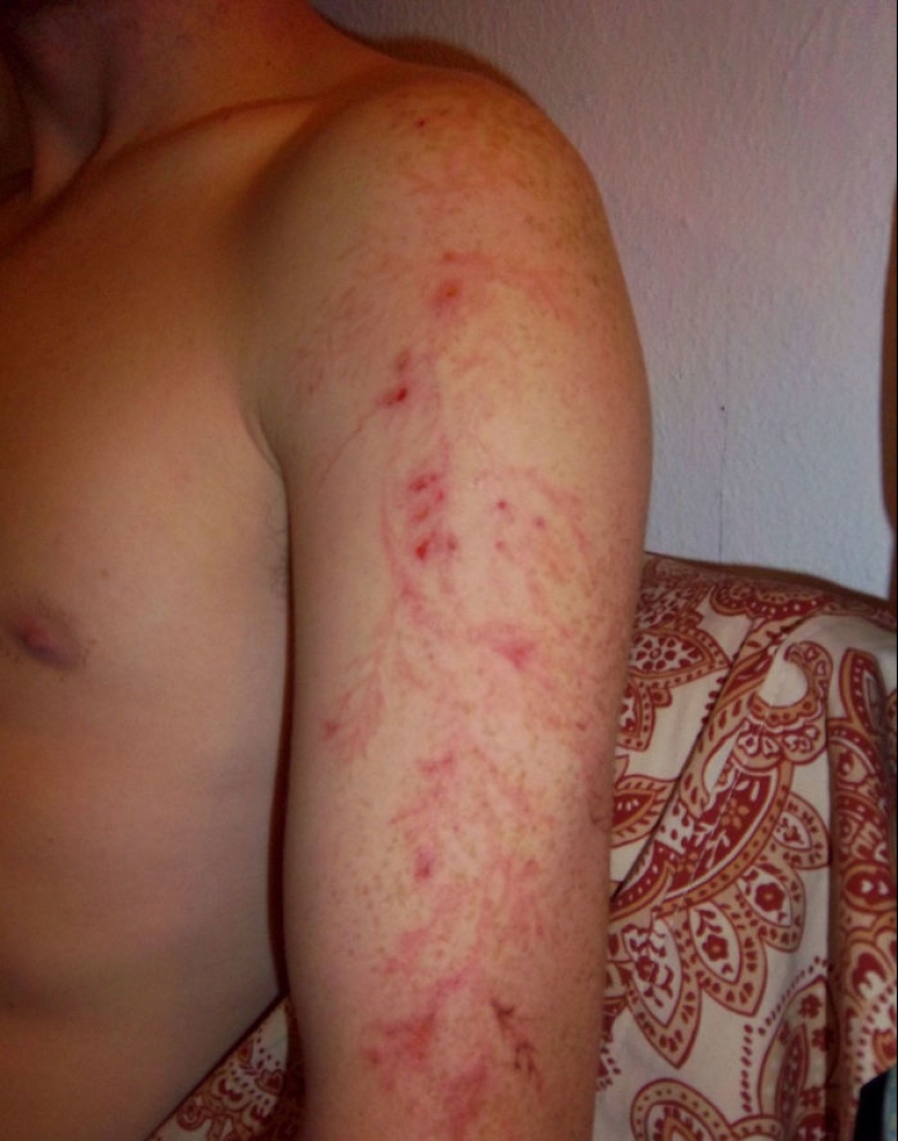 Después de la descarga: ¿qué le sucede a un hombre que fue alcanzado por un rayo