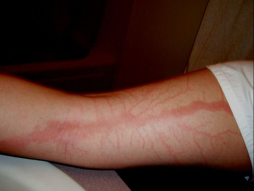 Después de la descarga: ¿qué le sucede a un hombre que fue alcanzado por un rayo