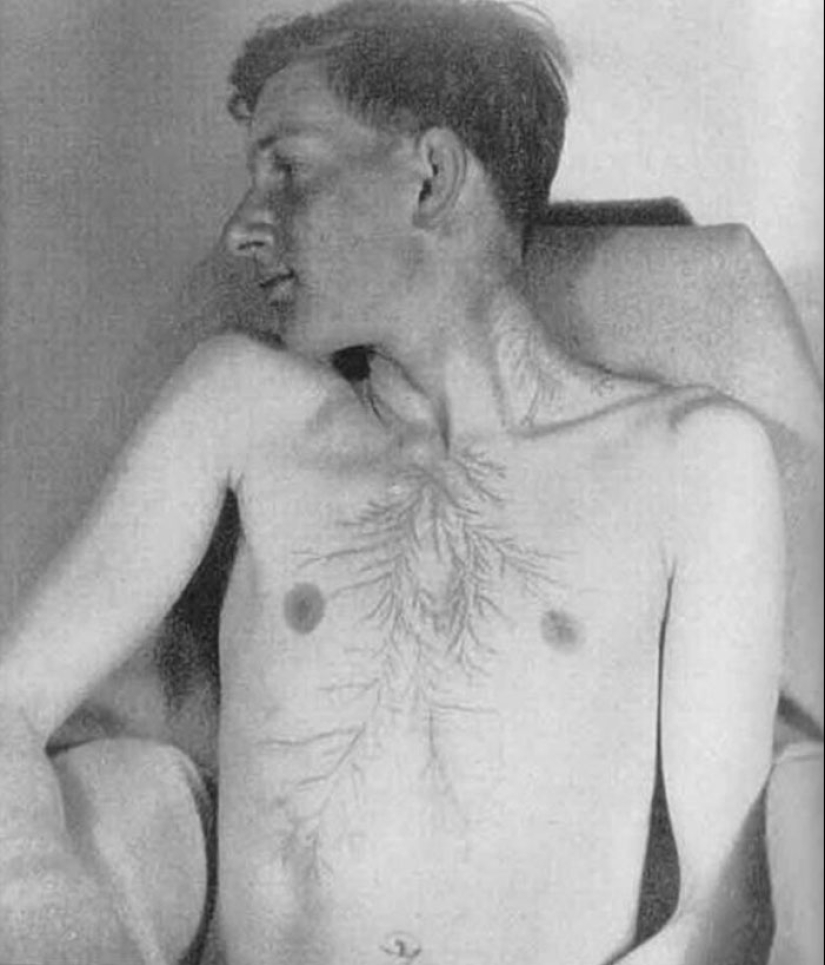 Después de la descarga: ¿qué le sucede a un hombre que fue alcanzado por un rayo