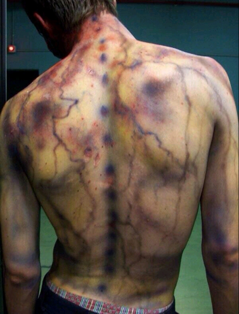 Después de la descarga: ¿qué le sucede a un hombre que fue alcanzado por un rayo