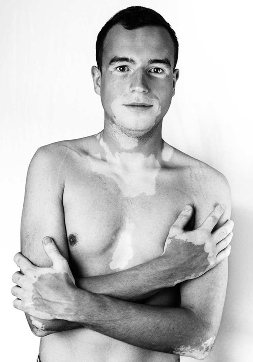 Discover the beauty of vitiligo Discover the beauty of vitiligo