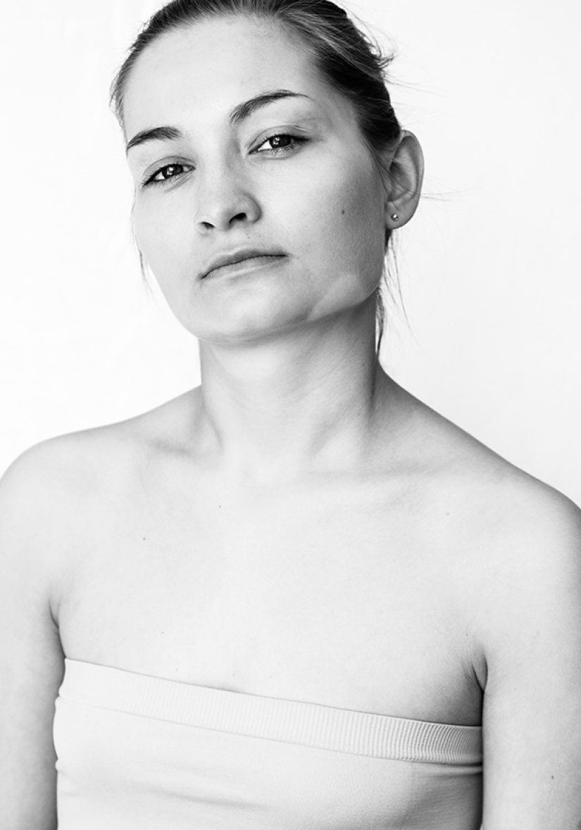 Discover the beauty of vitiligo Discover the beauty of vitiligo